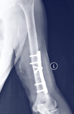 Würde die zweite Operation zur Entfernung von Schrauben und Platten ersparen: Implantatmaterial aus bioabbaubaren Mangesium 